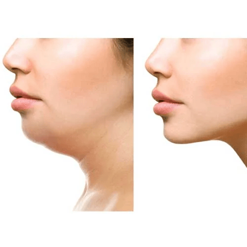 Before and After Skin Tightening