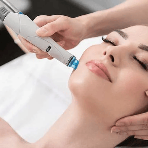 Dermabrasion treatment